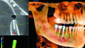 CBCT—种植选择的清晰透视