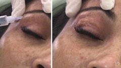 Ozonoterapia para revertir el envejecimiento facial