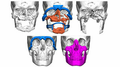 Planmeca ProModel technology part of first Nordic facial tissue transplant